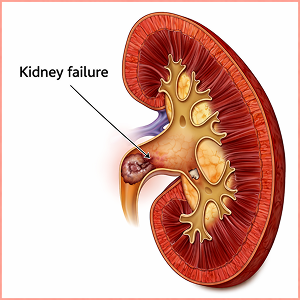 Nephropathy
